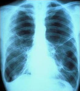 کاربرد اشعه ایکس در پزشکی